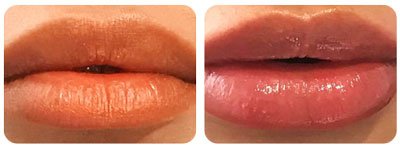 Lip Enhancement 